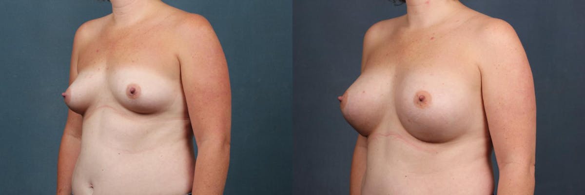 Enlargement - Silicone Before & After Gallery - Patient 415592 - Image 2
