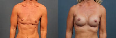 Enlargement - Silicone Before & After Gallery - Patient 385654 - Image 1