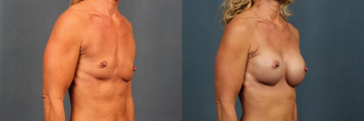 Enlargement - Silicone Before & After Gallery - Patient 385654 - Image 2