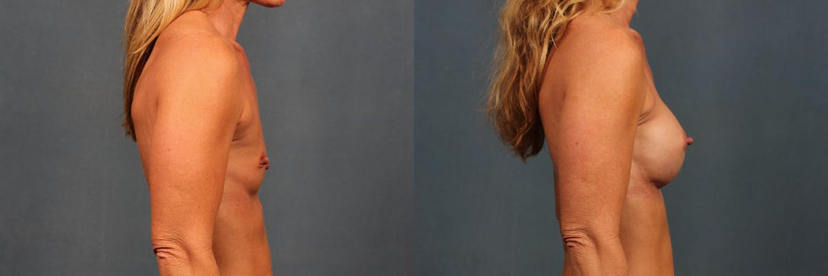 Enlargement - Silicone Before & After Gallery - Patient 385654 - Image 3