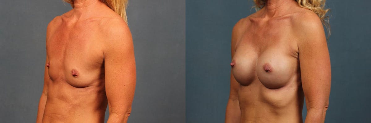 Enlargement - Silicone Before & After Gallery - Patient 385654 - Image 4