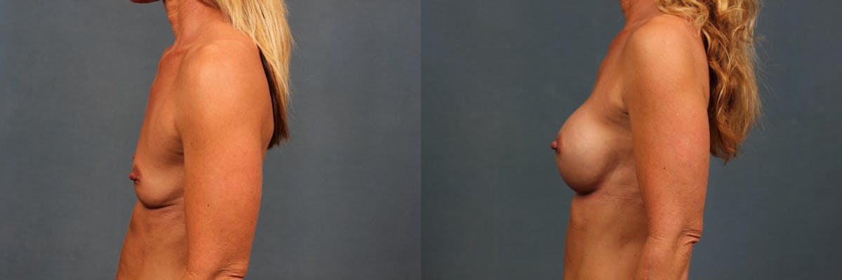 Enlargement - Silicone Before & After Gallery - Patient 385654 - Image 5