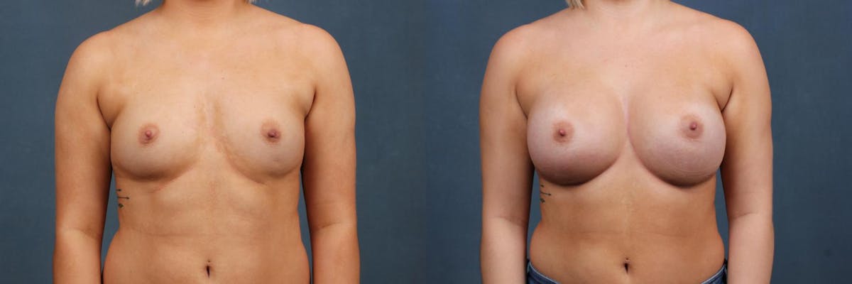 Enlargement - Silicone Before & After Gallery - Patient 274442 - Image 1