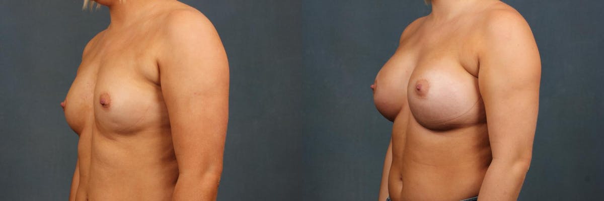 Enlargement - Silicone Before & After Gallery - Patient 274442 - Image 2