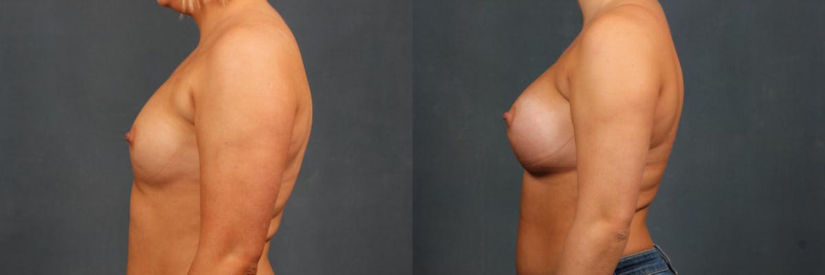 Enlargement - Silicone Before & After Gallery - Patient 274442 - Image 3