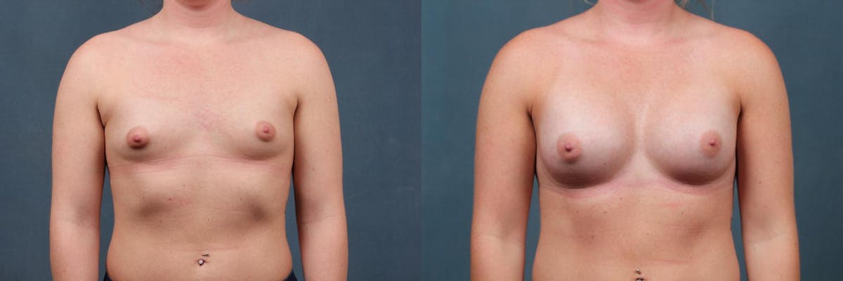 Enlargement - Silicone Before & After Gallery - Patient 333753 - Image 1