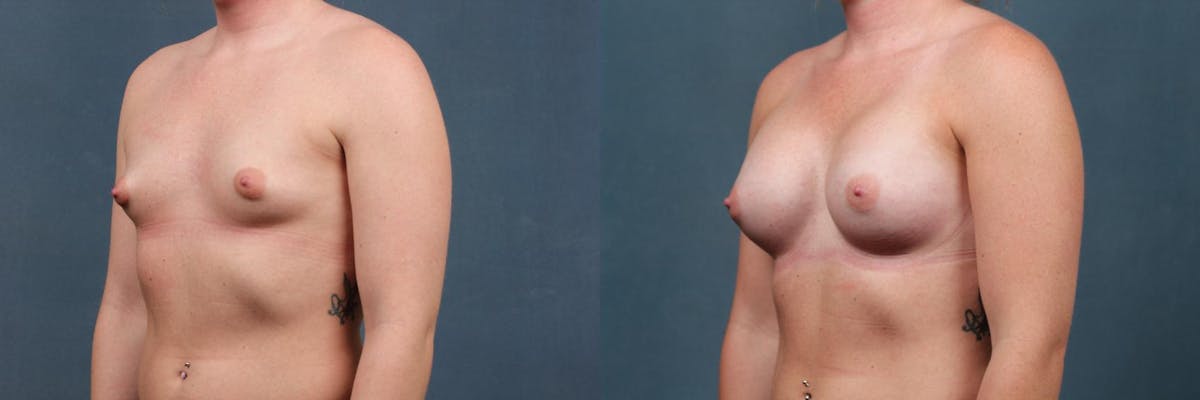 Enlargement - Silicone Before & After Gallery - Patient 333753 - Image 2
