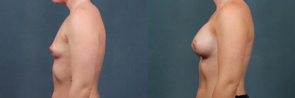 Enlargement - Silicone Before & After Gallery - Patient 333753 - Image 3