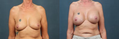 Enlargement - Silicone Before & After Gallery - Patient 149139 - Image 1