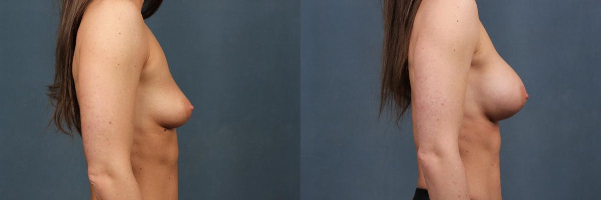 Enlargement - Silicone Before & After Gallery - Patient 395309 - Image 3