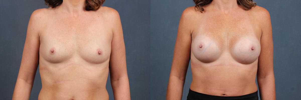 Enlargement - Silicone Before & After Gallery - Patient 261723 - Image 1