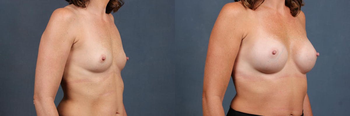 Enlargement - Silicone Before & After Gallery - Patient 261723 - Image 2