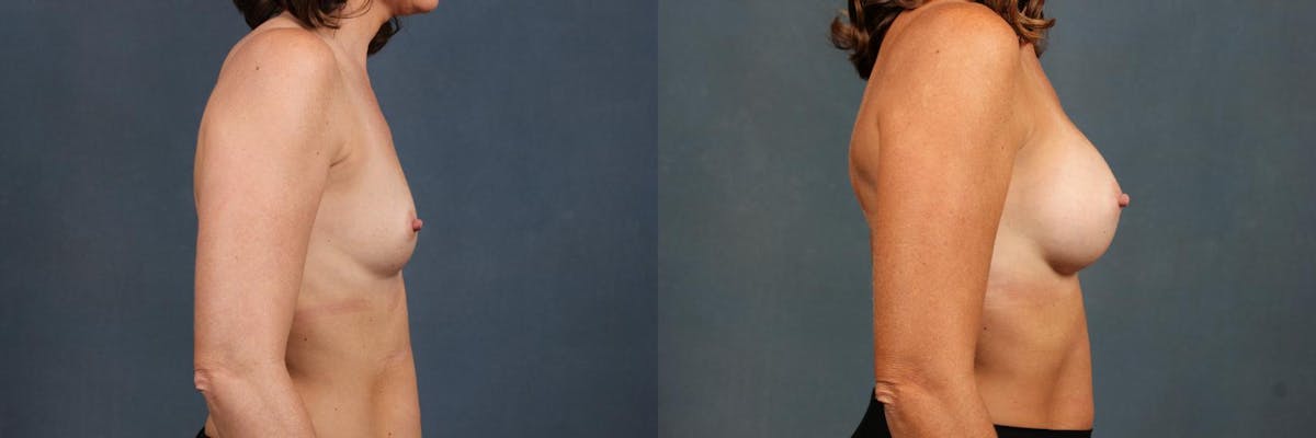 Enlargement - Silicone Before & After Gallery - Patient 261723 - Image 3