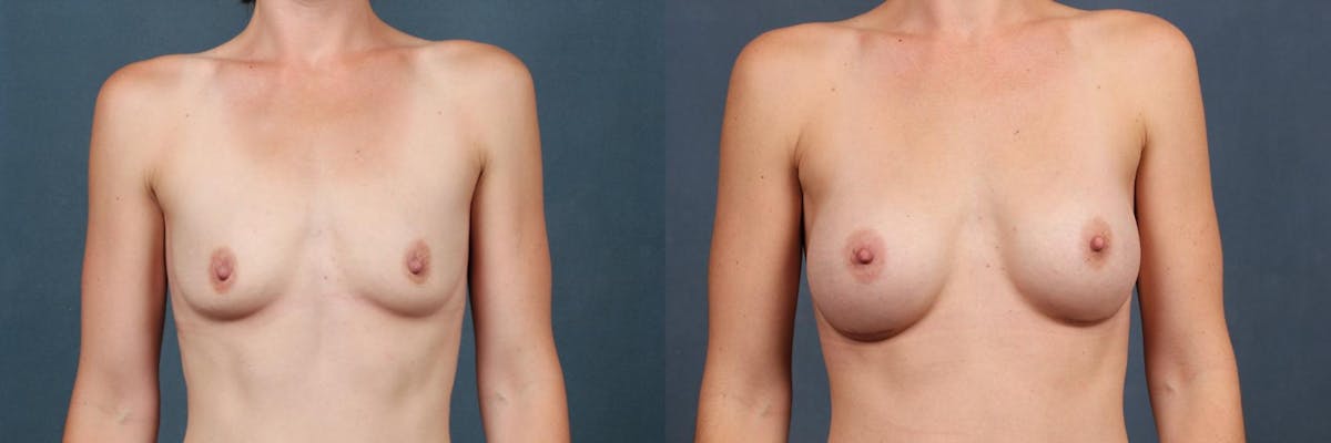 Enlargement - Silicone Before & After Gallery - Patient 629067 - Image 2