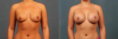 Enlargement - Silicone Before & After Gallery - Patient 254696 - Image 1