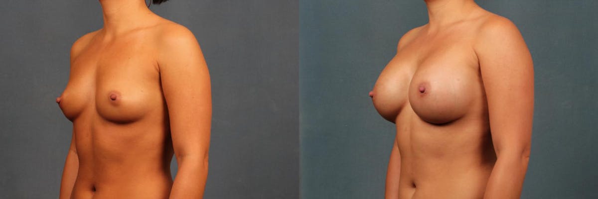 Enlargement - Silicone Before & After Gallery - Patient 254696 - Image 2