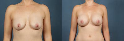Enlargement - Silicone Before & After Gallery - Patient 318430 - Image 1