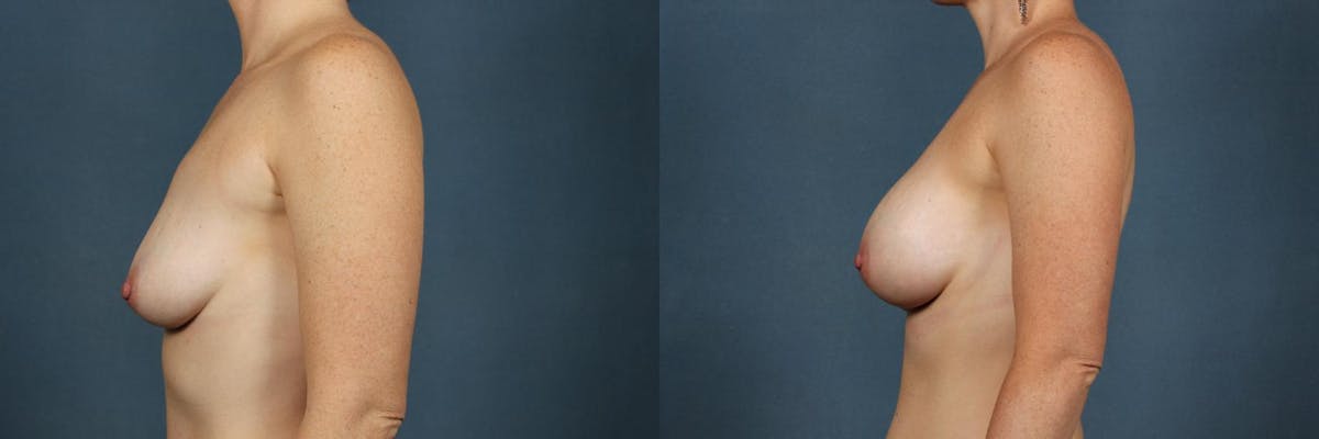 Enlargement - Silicone Before & After Gallery - Patient 318430 - Image 3