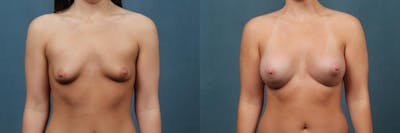 Enlargement - Silicone Before & After Gallery - Patient 357037 - Image 1