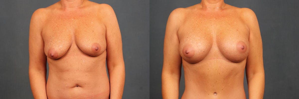 Enlargement - Silicone Before & After Gallery - Patient 352375 - Image 1