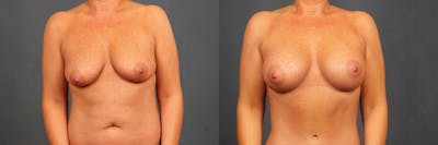 Enlargement - Silicone Before & After Gallery - Patient 352375 - Image 1