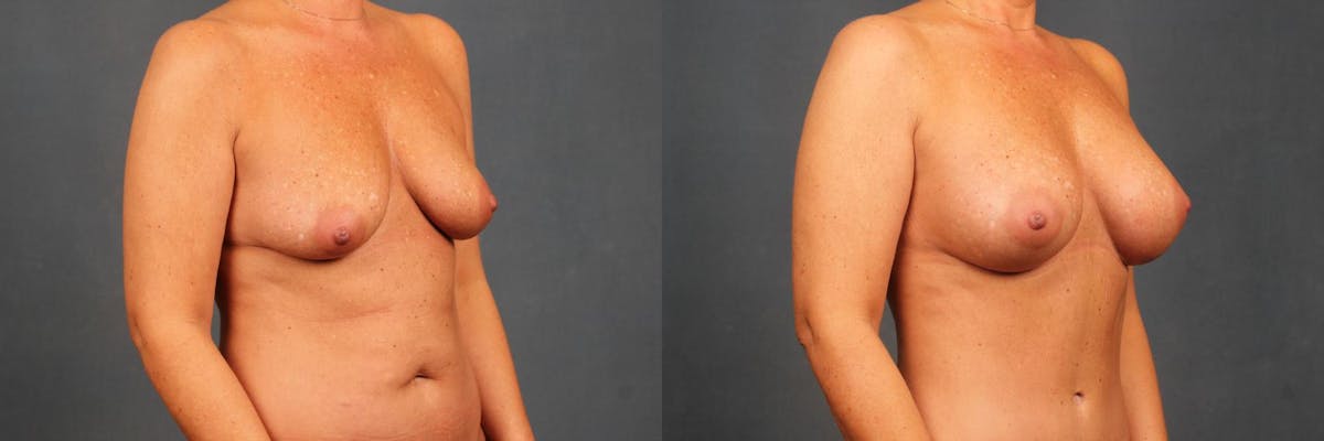 Enlargement - Silicone Before & After Gallery - Patient 352375 - Image 2