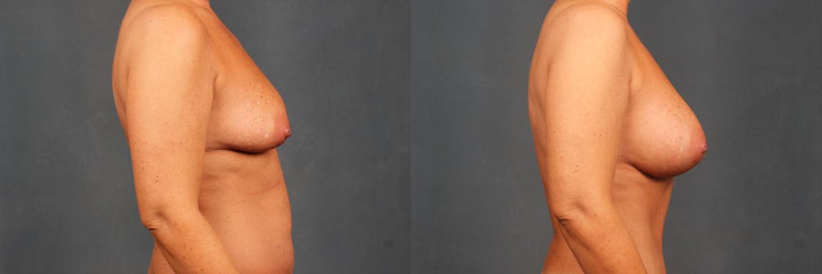 Enlargement - Silicone Before & After Gallery - Patient 352375 - Image 3