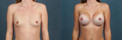 Enlargement - Silicone Before & After Gallery - Patient 155681 - Image 1