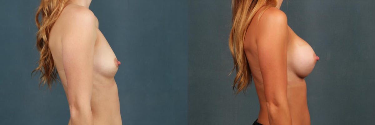 Enlargement - Silicone Before & After Gallery - Patient 155681 - Image 3