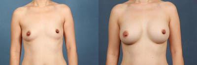Enlargement - Silicone Before & After Gallery - Patient 421378 - Image 1