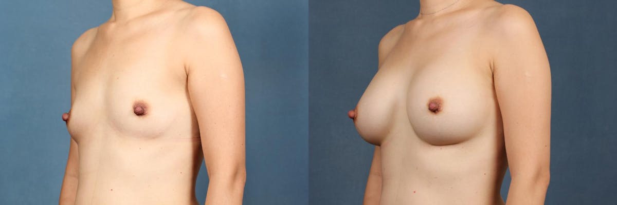 Enlargement - Silicone Before & After Gallery - Patient 421378 - Image 2