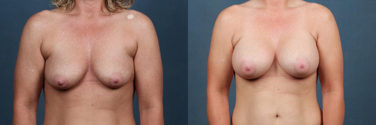 Enlargement - Silicone Before & After Gallery - Patient 923135 - Image 1