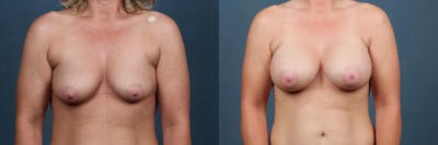 Enlargement - Silicone Before & After Gallery - Patient 923135 - Image 1