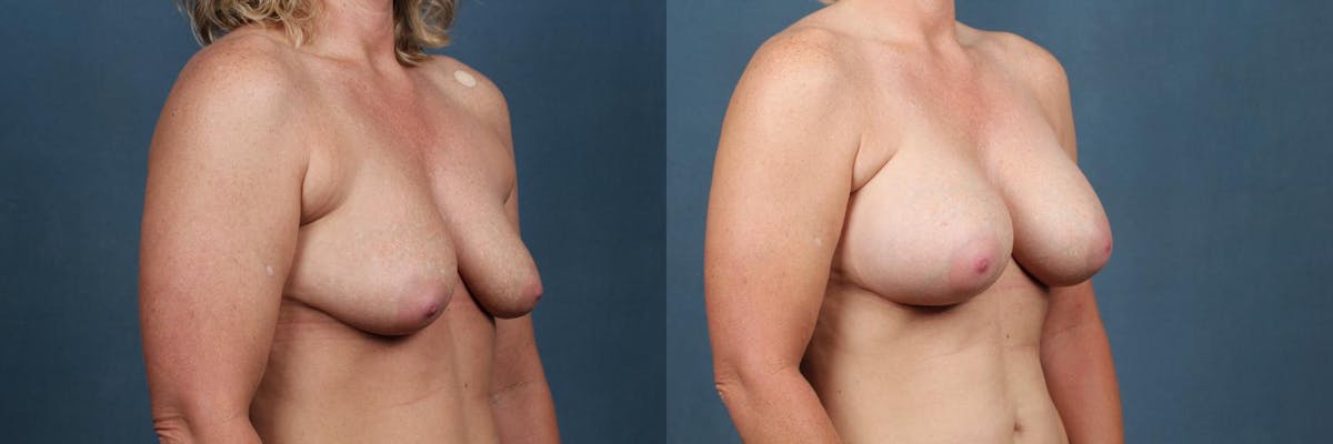Enlargement - Silicone Before & After Gallery - Patient 923135 - Image 2