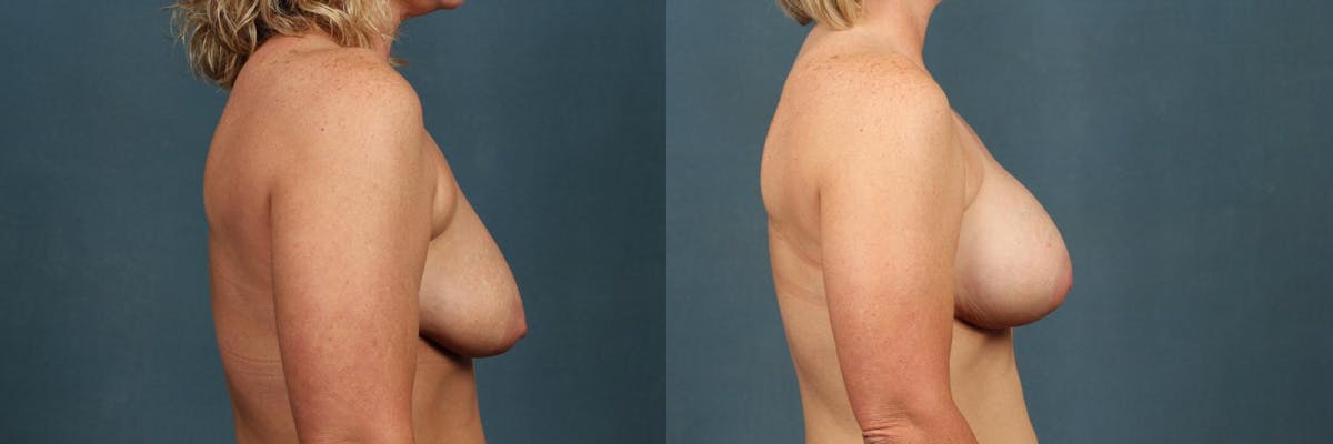 Enlargement - Silicone Before & After Gallery - Patient 923135 - Image 3