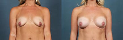 Enlargement - Silicone Before & After Gallery - Patient 161871 - Image 1