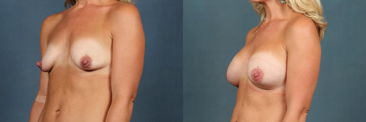 Enlargement - Silicone Before & After Gallery - Patient 161871 - Image 2