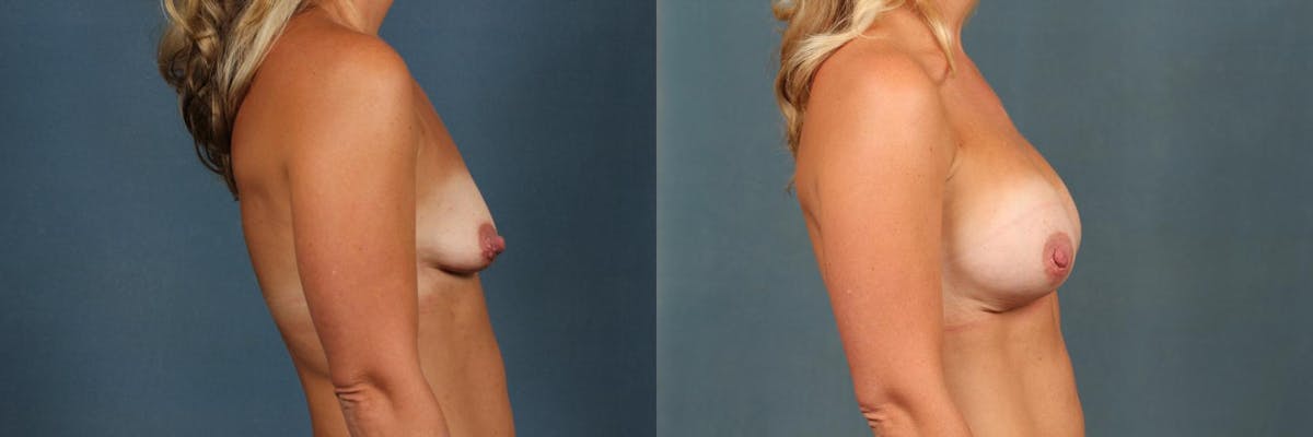 Enlargement - Silicone Before & After Gallery - Patient 161871 - Image 3