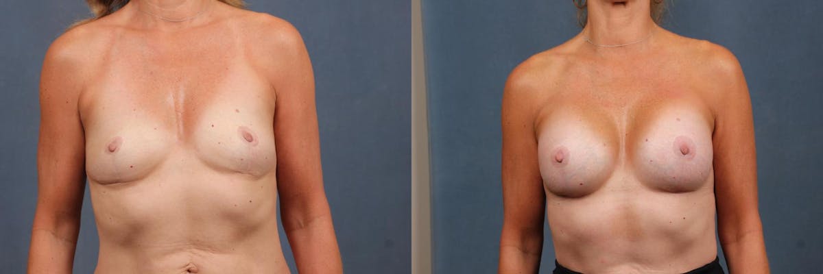 Lift Before & After Gallery - Patient 699273 - Image 1