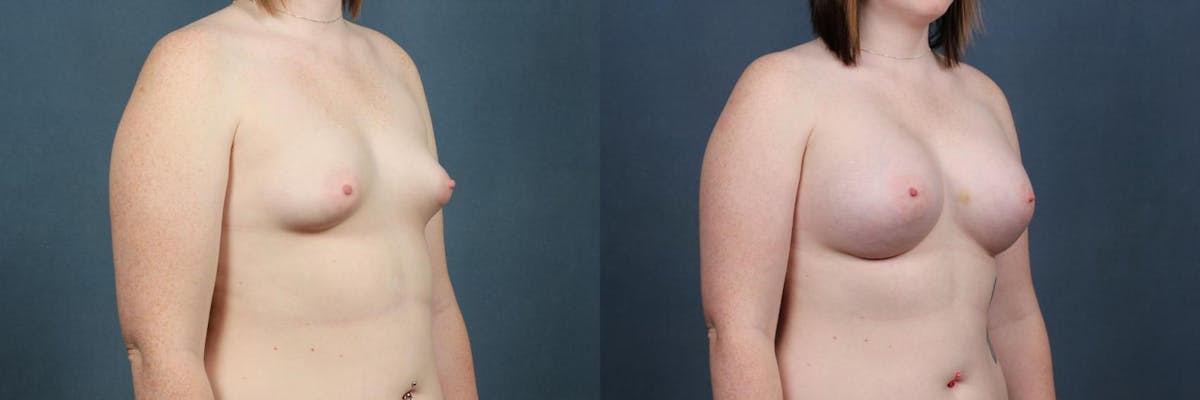 Enlargement - Silicone Before & After Gallery - Patient 357327 - Image 1
