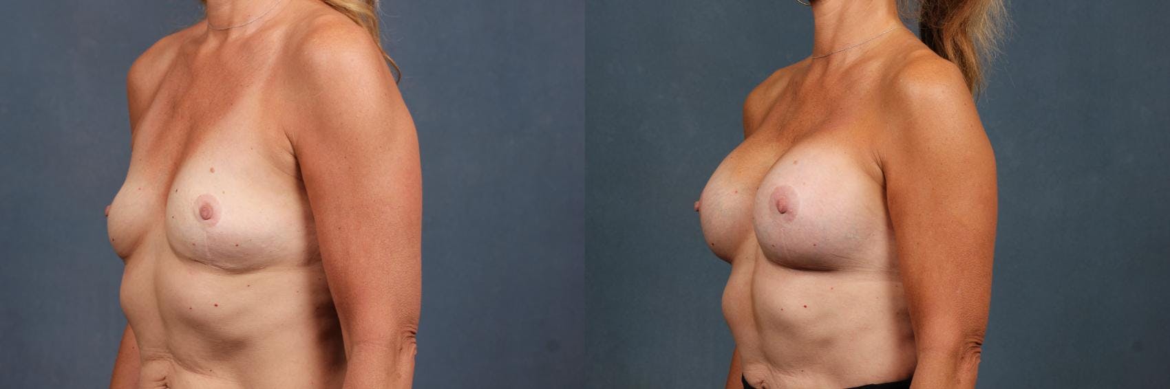 Lift Before & After Gallery - Patient 699273 - Image 2