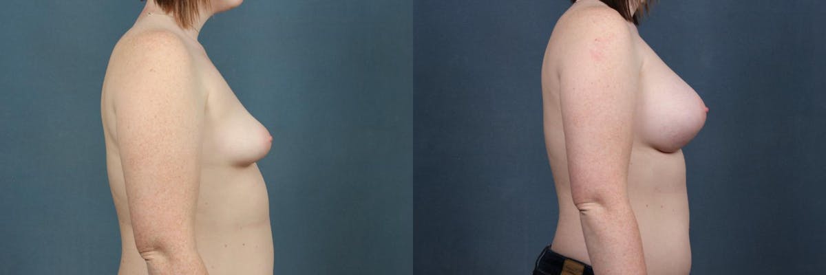 Enlargement - Silicone Before & After Gallery - Patient 357327 - Image 2