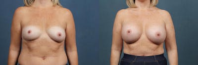 Enlargement - Silicone Before & After Gallery - Patient 272684 - Image 1