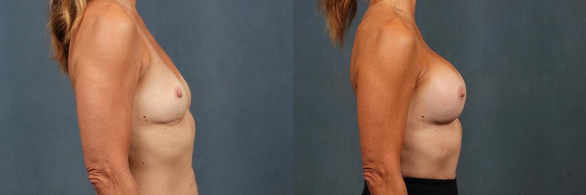 Lift Before & After Gallery - Patient 699273 - Image 3