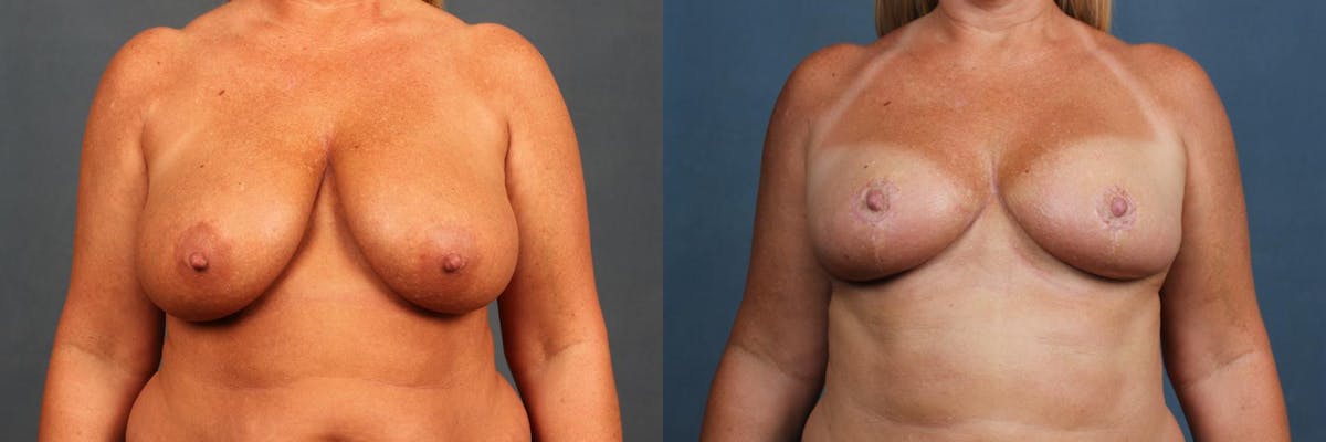 Lift Before & After Gallery - Patient 419640 - Image 1
