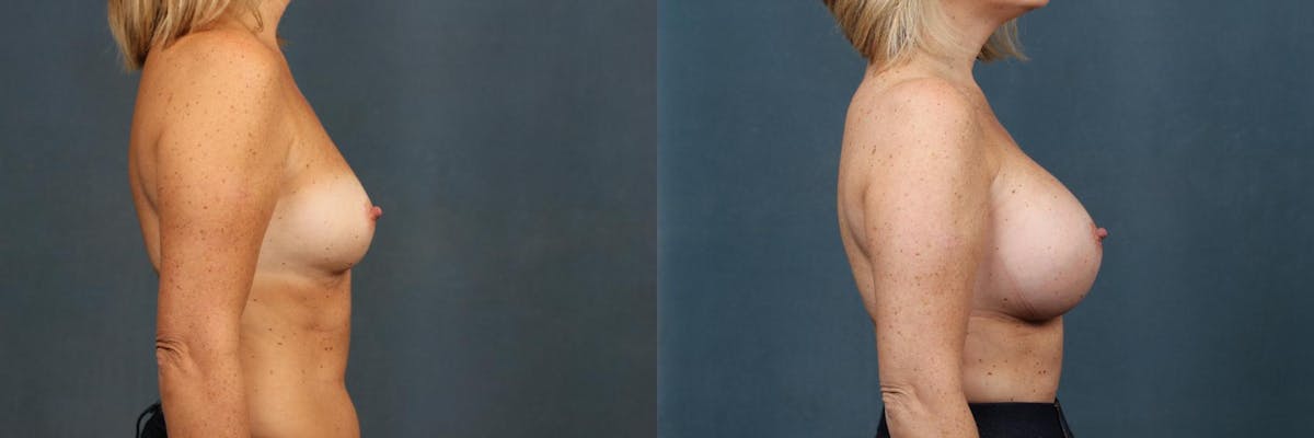 Enlargement - Silicone Before & After Gallery - Patient 272684 - Image 3