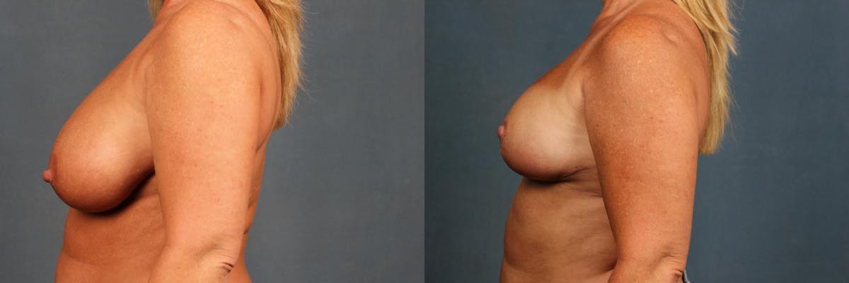 Lift Before & After Gallery - Patient 419640 - Image 3