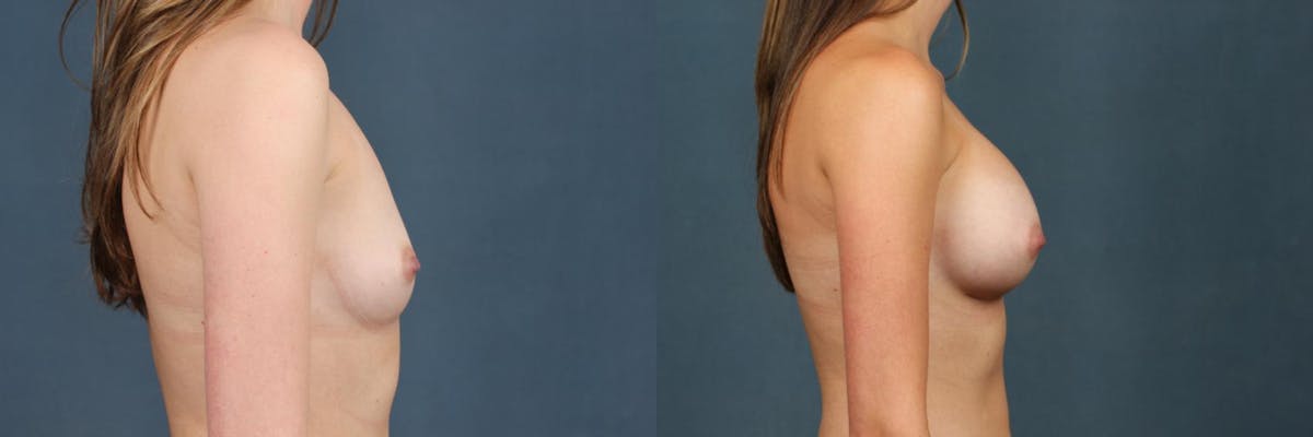 Enlargement - Silicone Before & After Gallery - Patient 117611 - Image 5