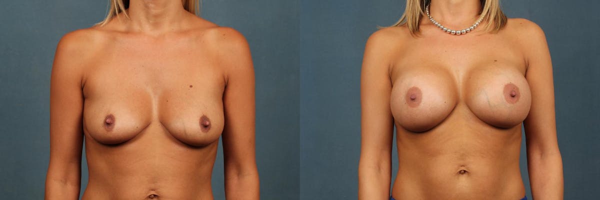 Enlargement - Silicone Before & After Gallery - Patient 680023 - Image 1