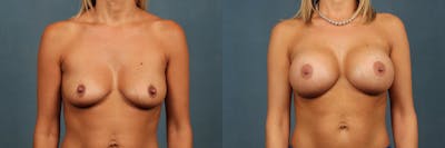 Enlargement - Silicone Before & After Gallery - Patient 680023 - Image 1